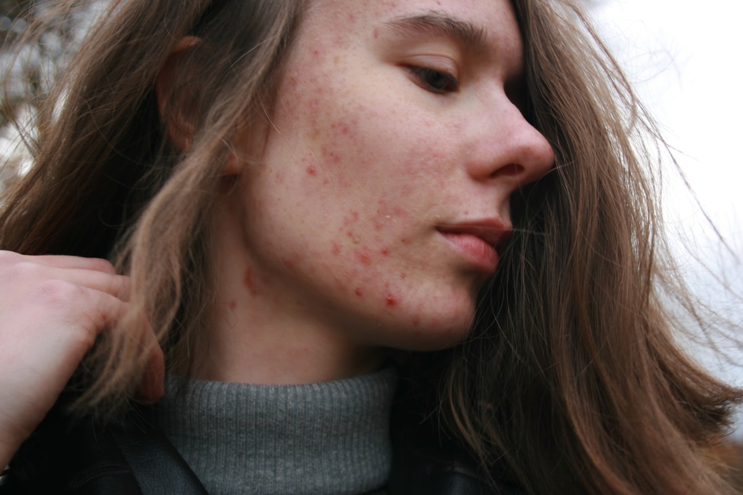 Sensitive Skin Care: Dos and Don’ts for Teens